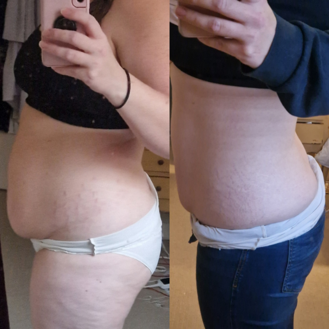 my own c-section overhang transformation